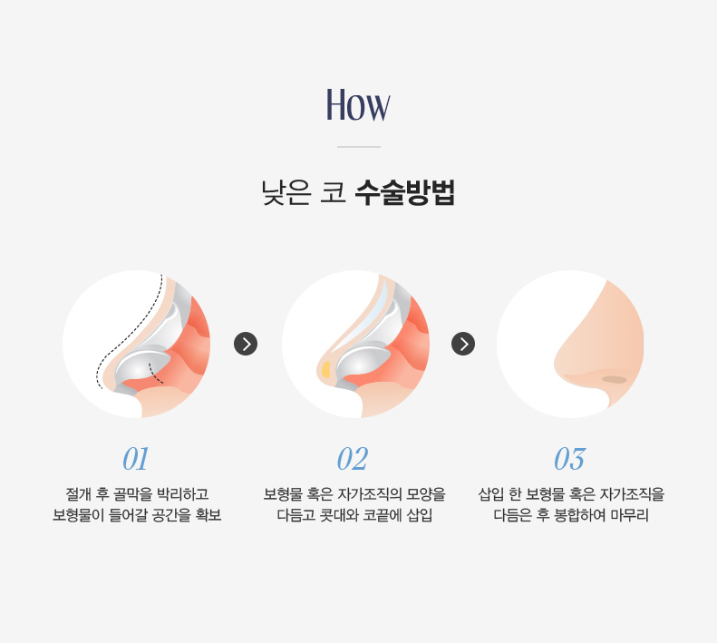 낮은 코 수술 노하우