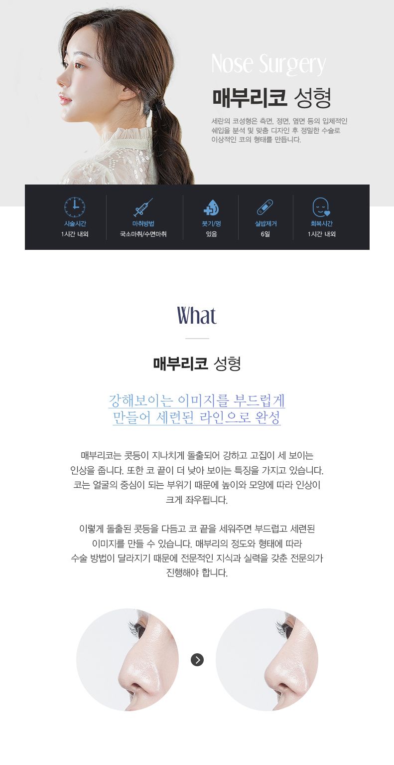 매부리코 성형이란?