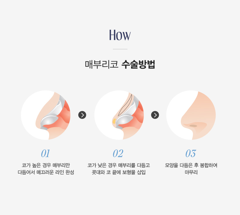 매부리코 성형