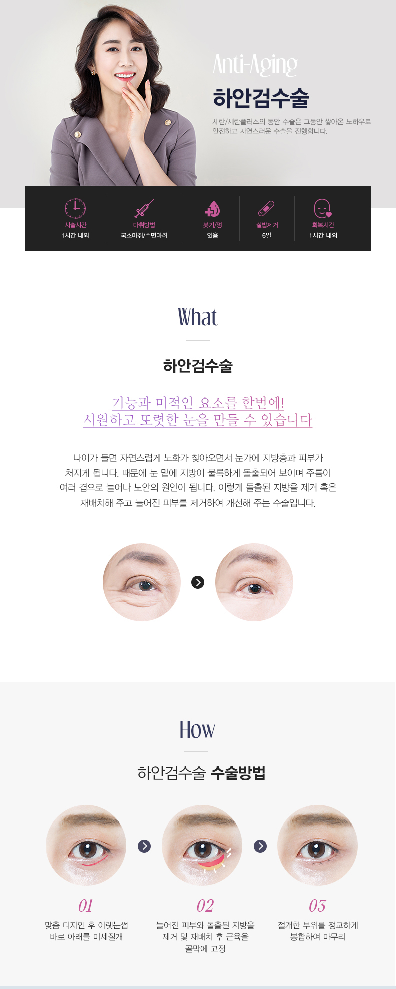 하안검수술